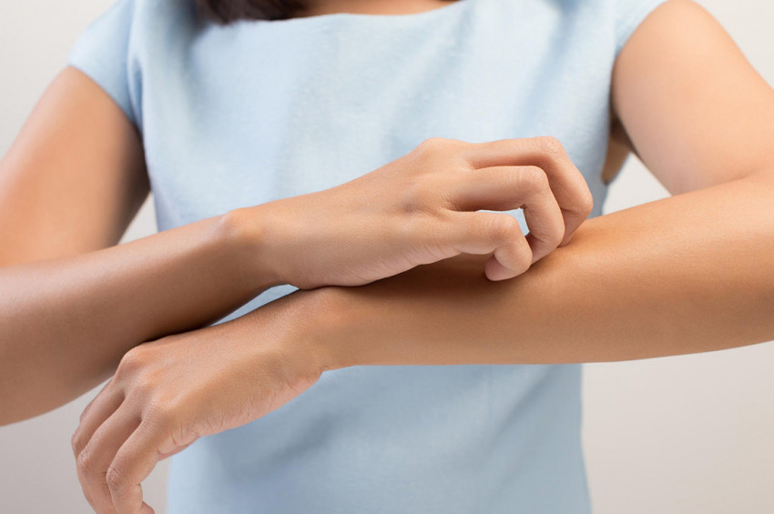 Türkiyede en az 700 bin sedef hastası var