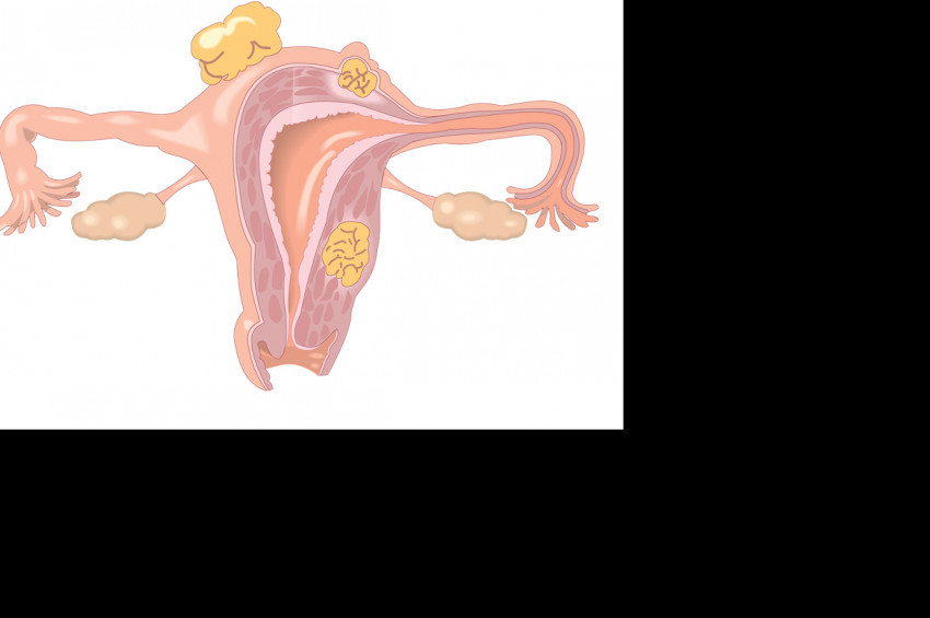 Her 3 kadından birinde miyom görülüyor