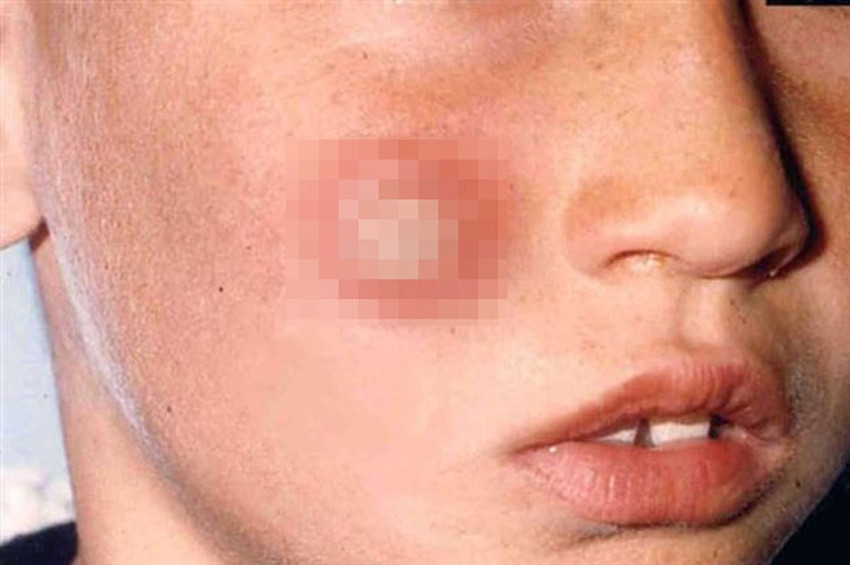 Güzellik yarası denilen şark çıbanı azalıyor