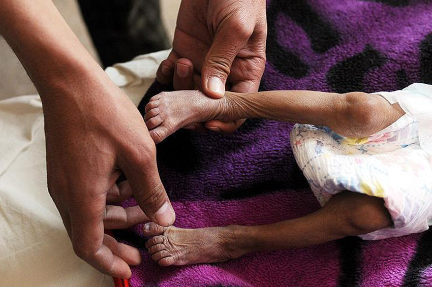 Yemendeki difteri salgını endişe veriyor