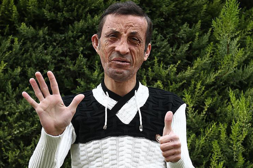 Yüz nakli yapılan Uğur Acarın yüzü gülüyor