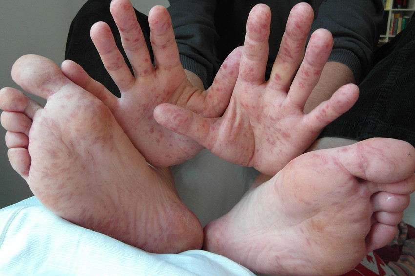 El ayak ağız hastalığı nedir?