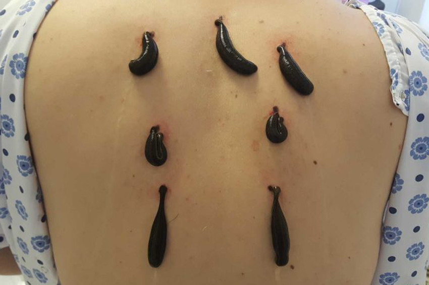 Sülükler 2 bin 500 yıldır tedavi ediyor