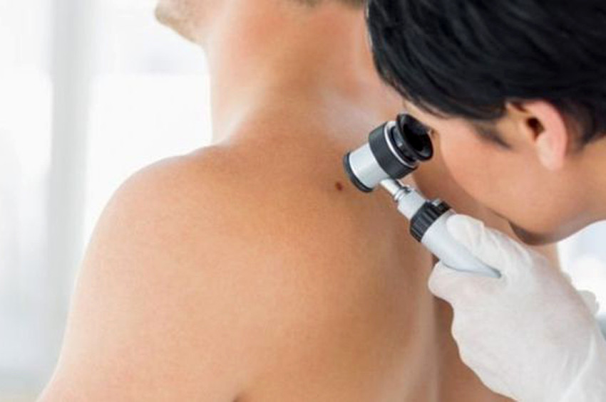 Avrupada cilt kanseri hızla yayılıyor