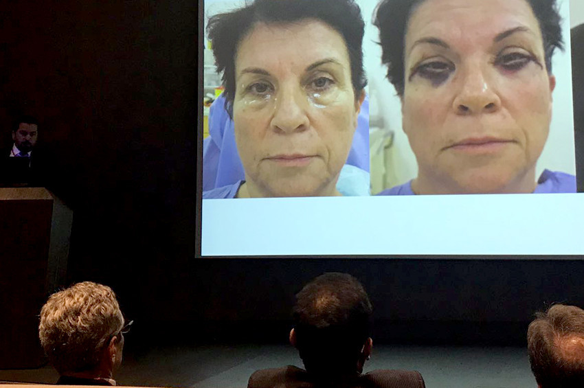 Göz kapağı cerrahisi, estetikten öte müdahaledir