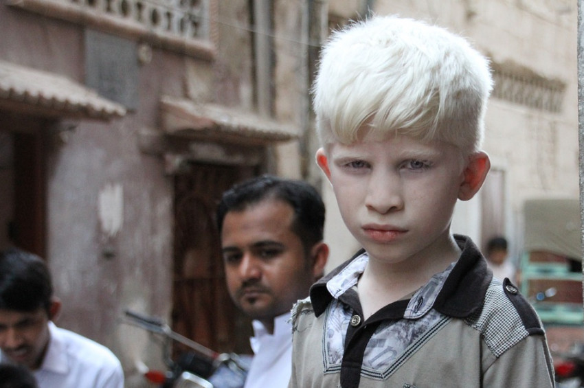 13 Haziran Albino farkındalık günü