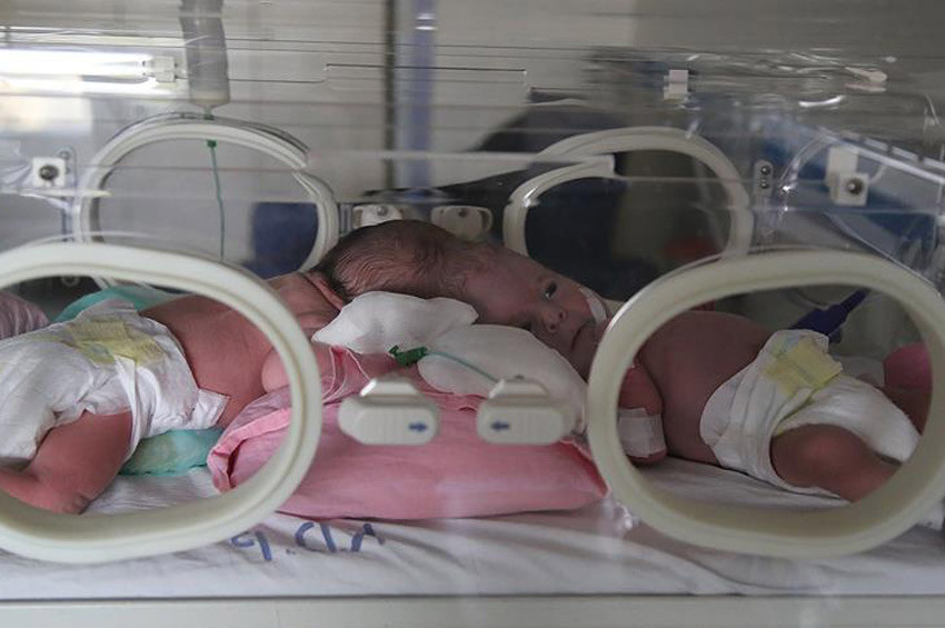 Antalyalı yapışık ikizlerin yaşam savaşı