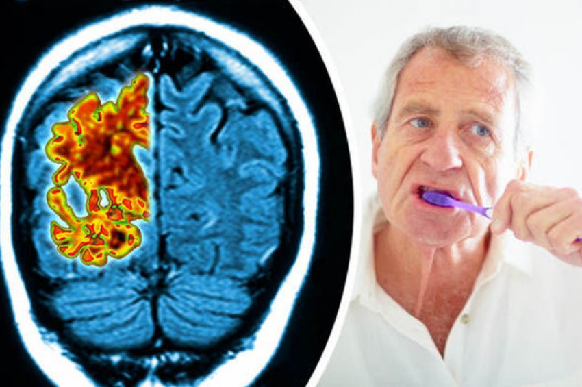 Diş eti hastalığı ile Alzheimer ilişkisi araştırılıyor