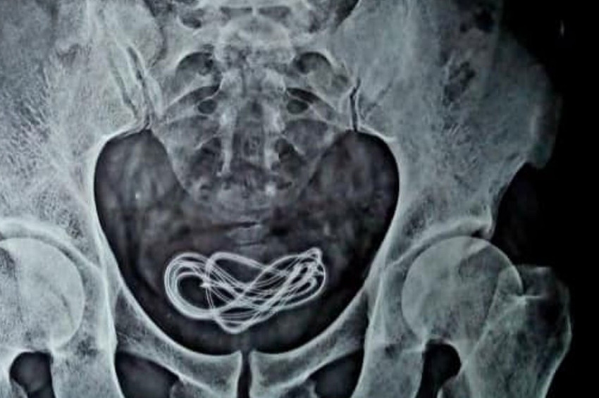 Bir Adamın Mesanesinden 61 cm’lik Şarj Kablosu Çıkarıldı