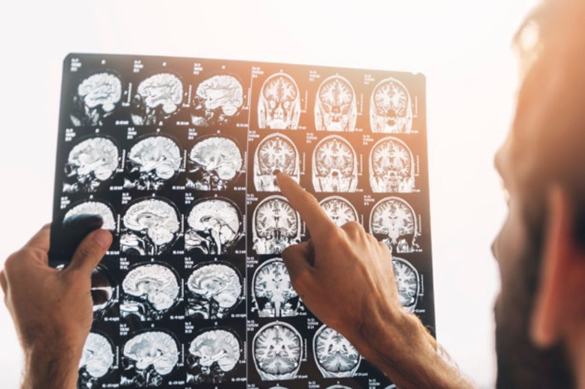 Beyin tümörü konusunda bilinmesi gereken tıbbi gerçekler