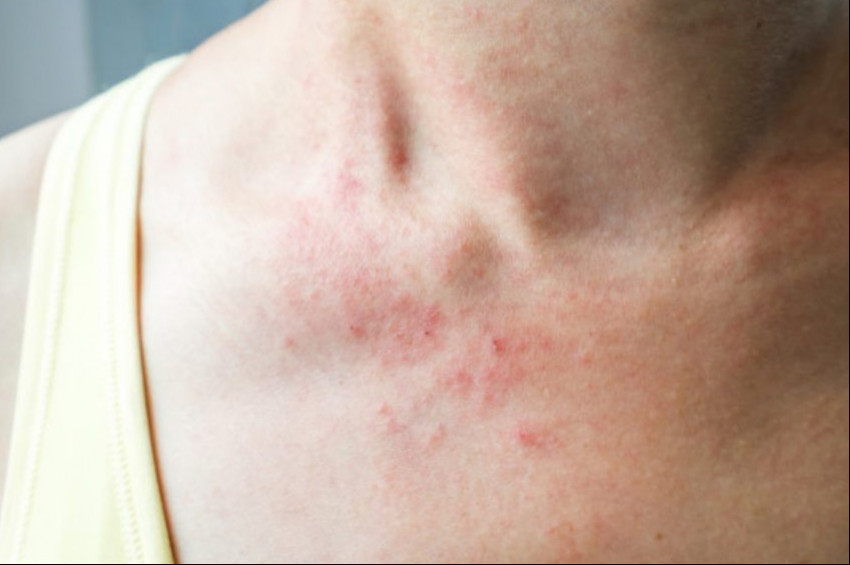 Altıncı Hastalık: Roseola infantum