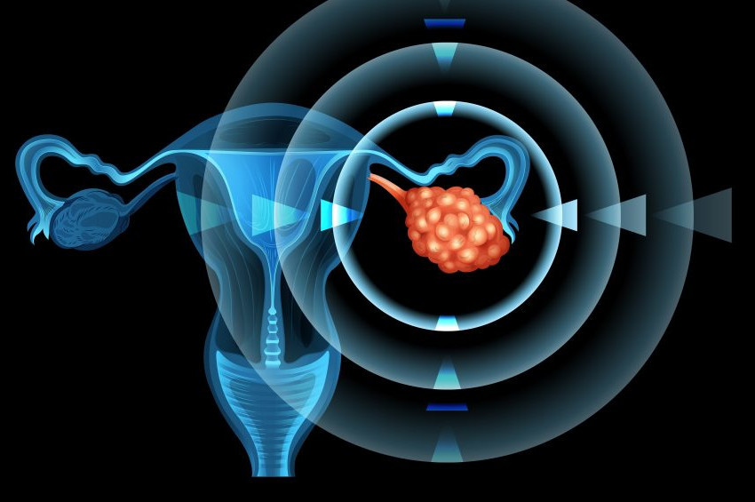 Yumurtalık kanserinde risk artırıcı faktörler