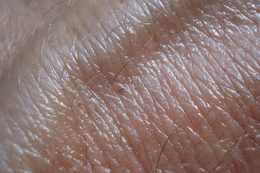 Cilt kanserine yol açabilecek 12 sağlık riski