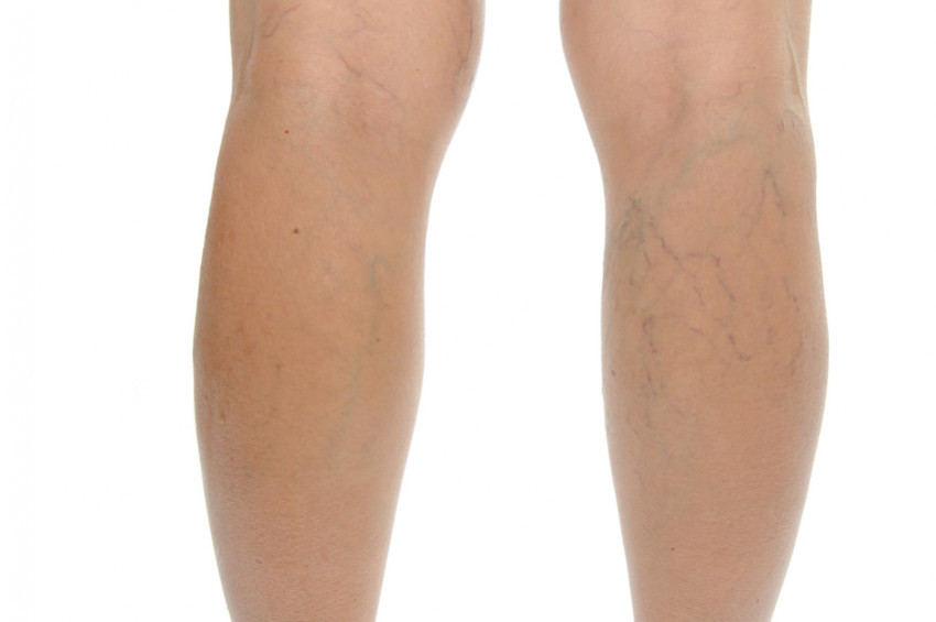 Varisi riskini artıran haller ve korunmak için öneriler