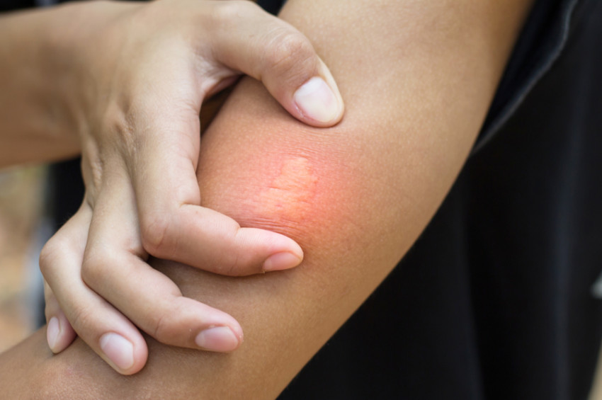 Böcek sokması halinde ne yapmalı?