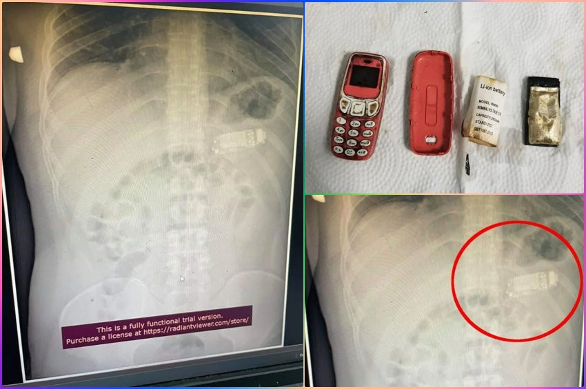 Cep telefonu yutan adam doktorları şaşırttı