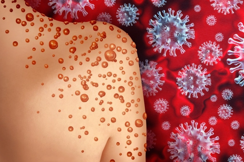 Maymun Çiçeği Virüsüyle ilgili bilinmesi gereken 5 önemli nokta