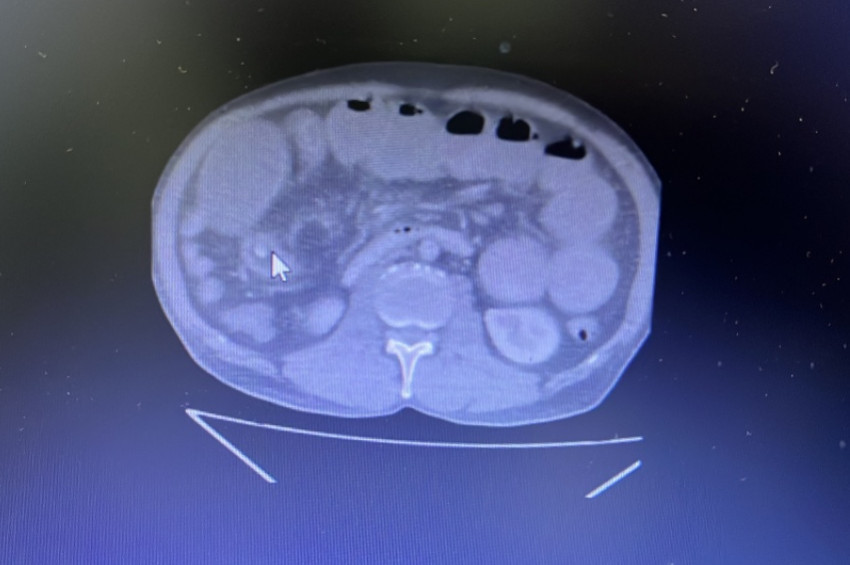Mide yanmasına iyi gelir diye zeytin yuttu, hastanelik oldu!