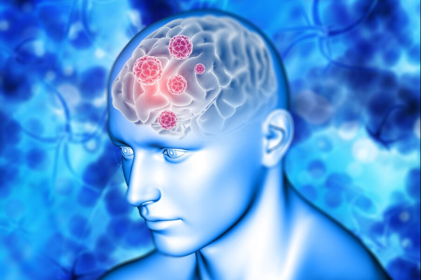 Beyin çürümesi nedir? Belirtileri ve nedenleri nelerdir?