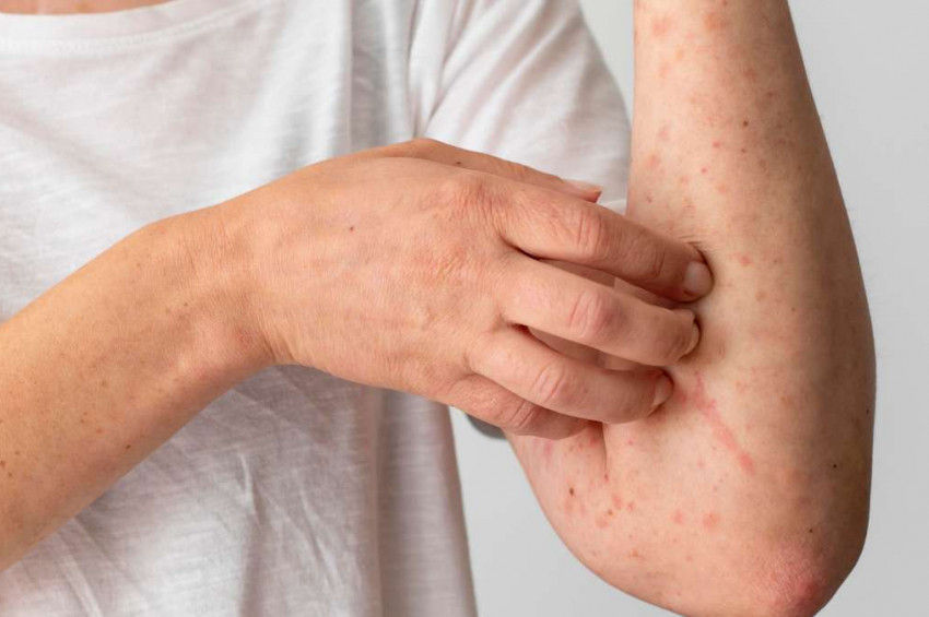 Kırım Kongo Kanamalı Ateşi Hastalığı hakkında bilinmesi gerekenler