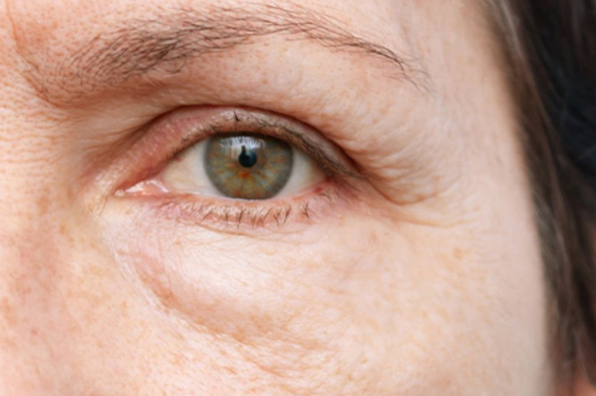 Göz Altı Torbaları ve şişlikleri ne zaman tehlikelidir?